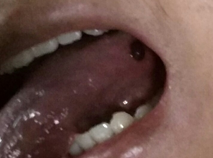 舌头长血泡