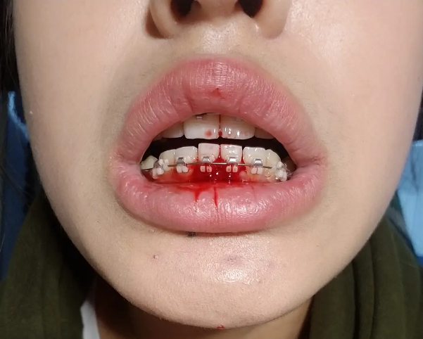 牙龈出血