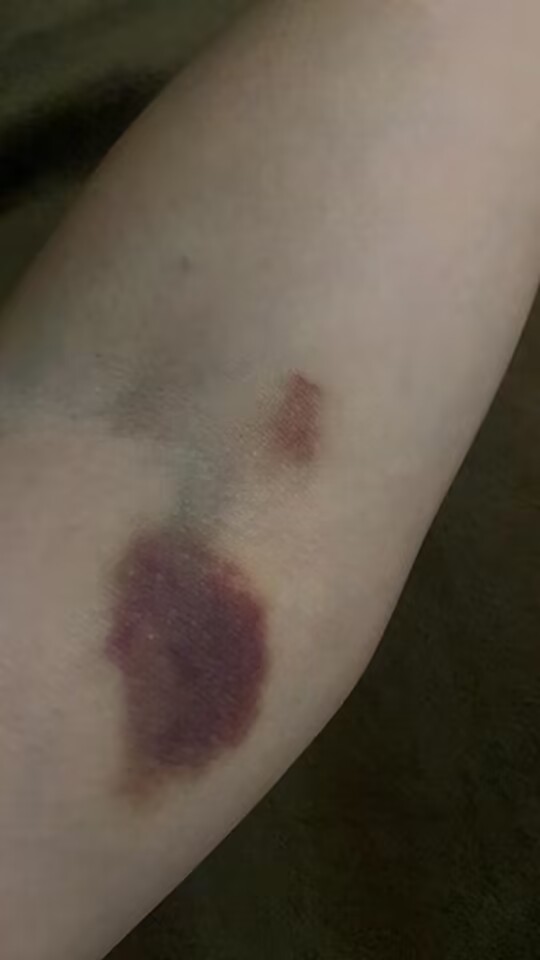 紫癜淤青出血点