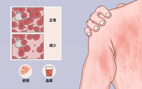 血小板减少症治疗方案,升血小板效果很好!