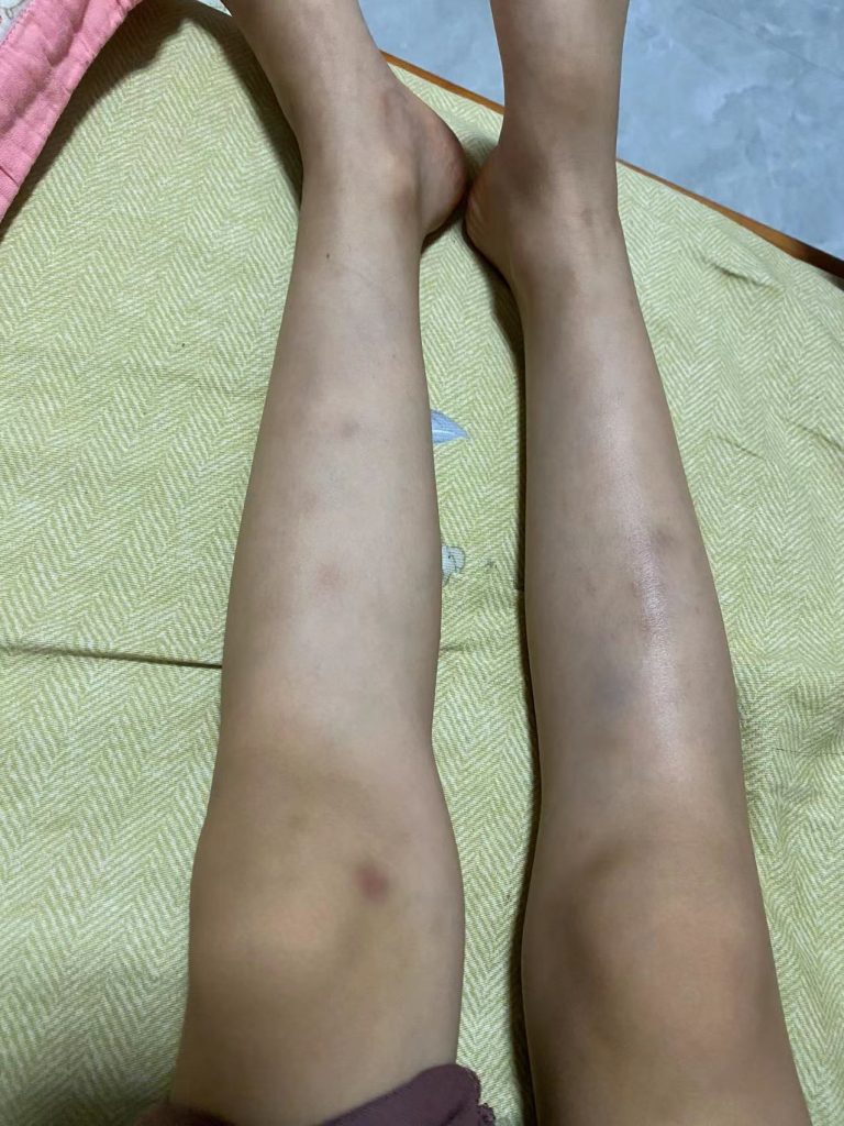 血小板减少淤青紫癜