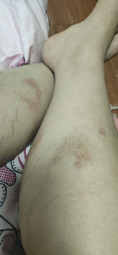 血小板减少淤青紫癜