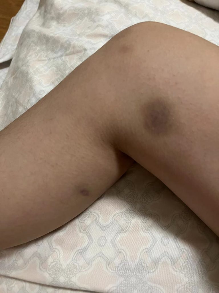 血小板减少出血点淤青紫癜