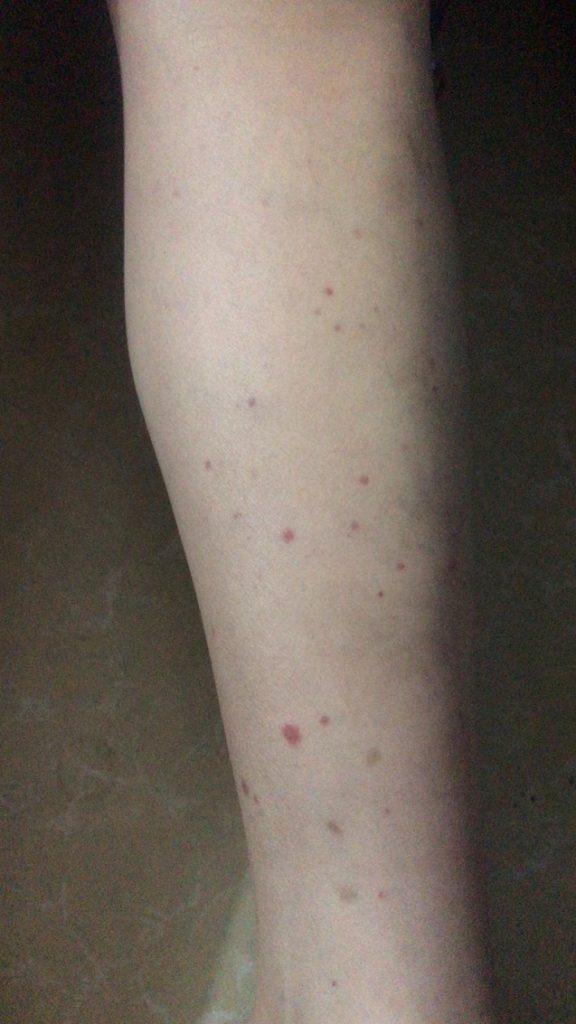 血小板减少出血点