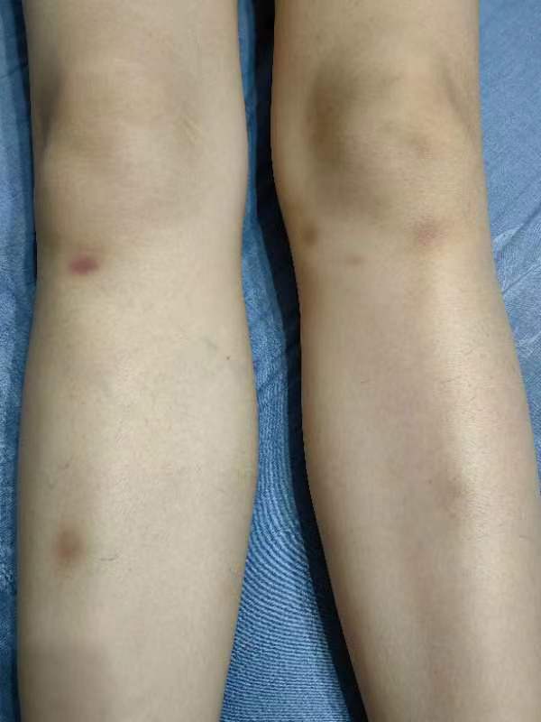 血小板减少淤青紫癜