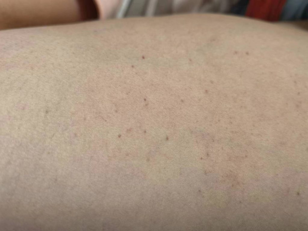血小板减少皮肤出血点紫癜