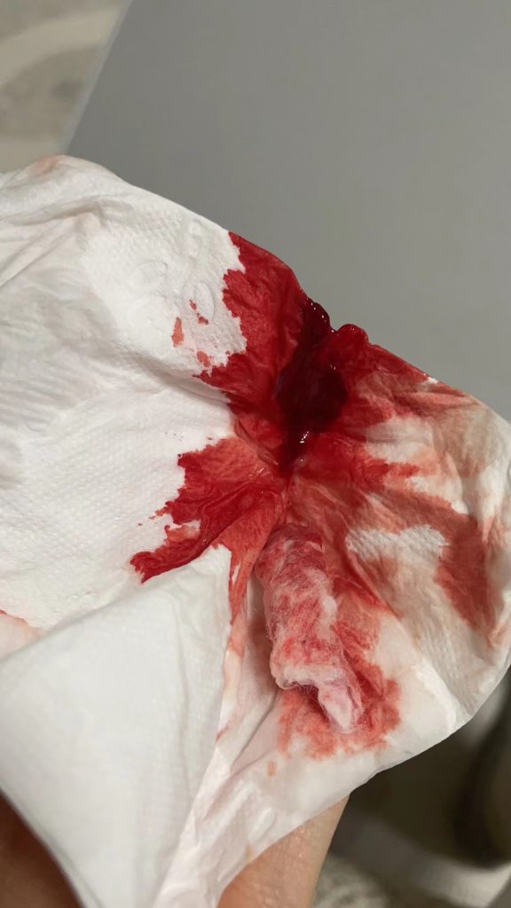 血小板减少鼻子出血