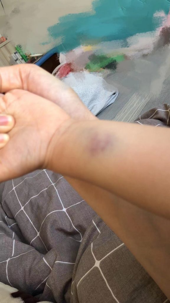 血小板减少皮肤淤青紫癜