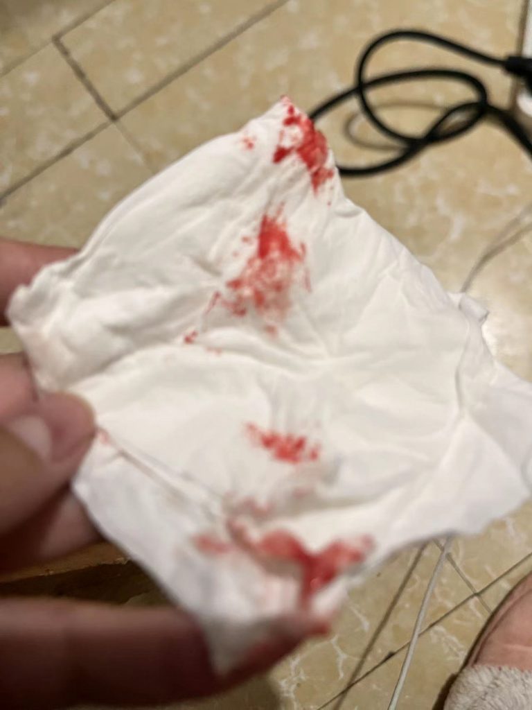 血小板减少鼻子出血