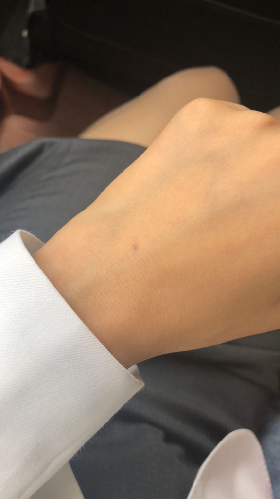 手上一个出血点