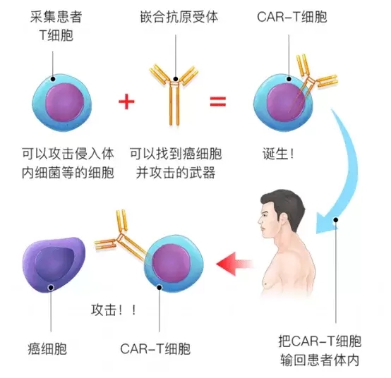 培养好的CAR-T细胞输送回患者体内